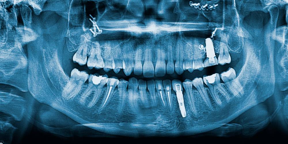 Aktien zu Implantate