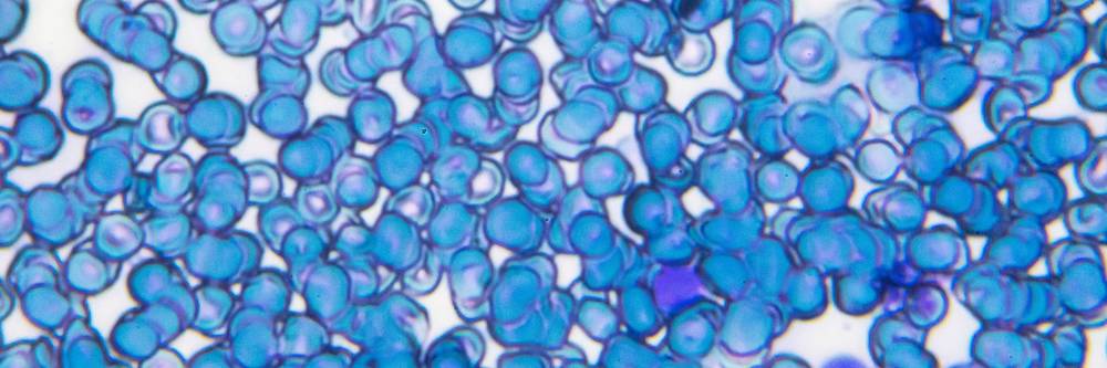 Aktien zu Blutkrebspharmazeutika