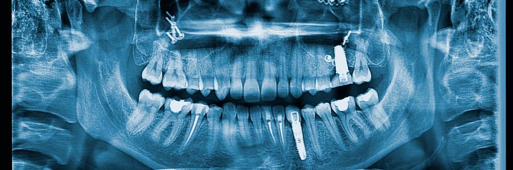 Aktien zu Implantate