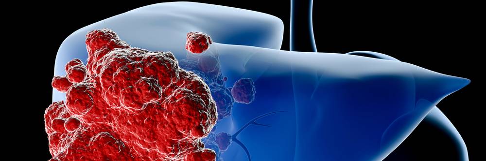 Aktien zu Leberkrebspharmazeutika