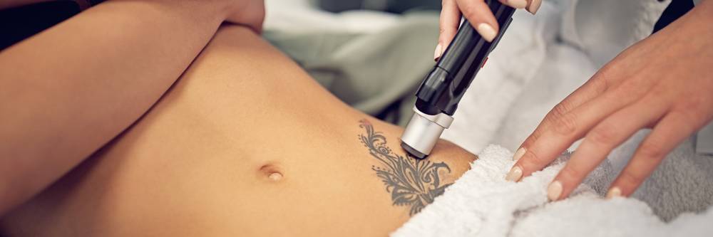 Aktien zu Tattooentfernung